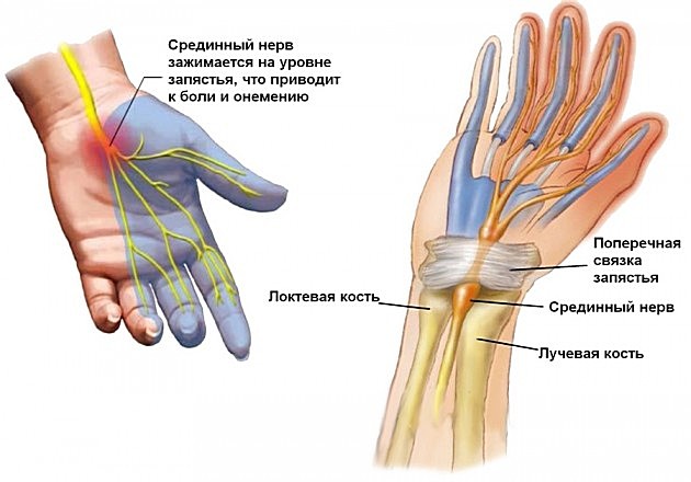 кистевой туннельный синдром